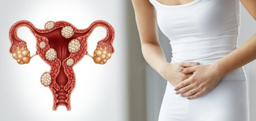 фибромиома матки что это симптомы и лечение