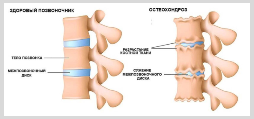 можно ли заниматься йогой при остеохондрозе,